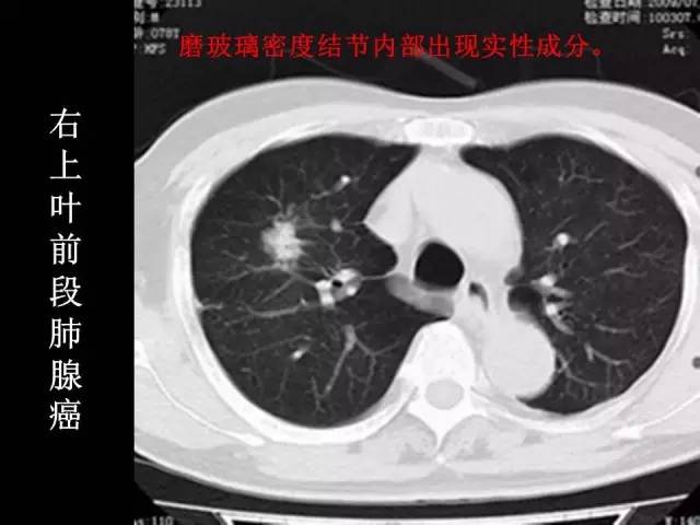 【PPT】肺内孤立性小结节的CT诊断探析