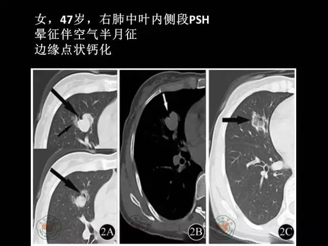 【PPT】肺内孤立性小结节的CT诊断探析