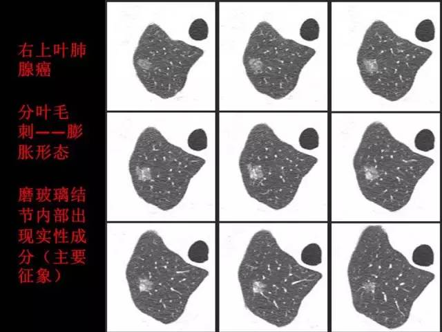 【PPT】肺内孤立性小结节的CT诊断探析