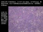 肺内孤立性小结节的CT诊断探析
