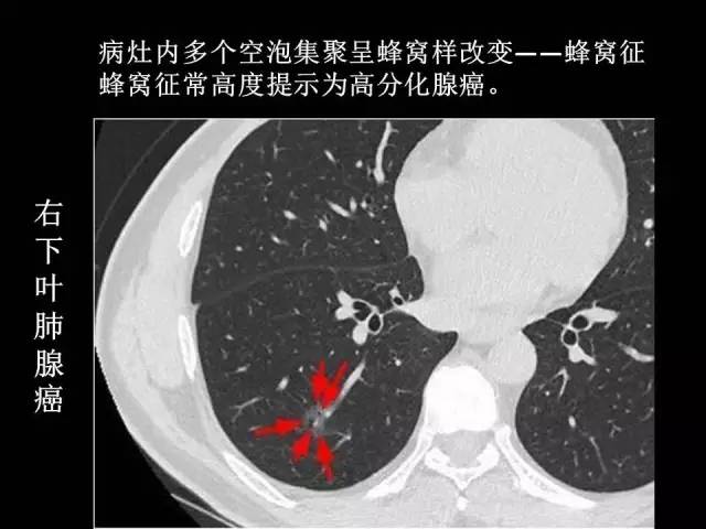 【PPT】肺内孤立性小结节的CT诊断探析