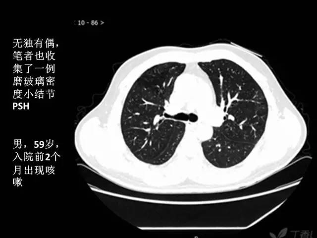【PPT】肺内孤立性小结节的CT诊断探析