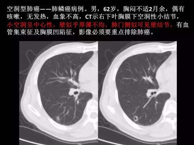 【PPT】肺内孤立性小结节的CT诊断探析