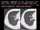 肺内孤立性小结节的CT诊断探析
