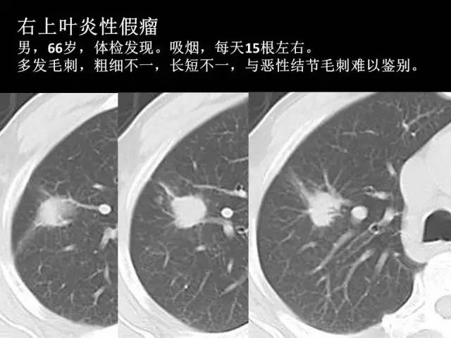 【PPT】肺内孤立性小结节的CT诊断探析