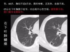 肺内孤立性小结节的CT诊断探析