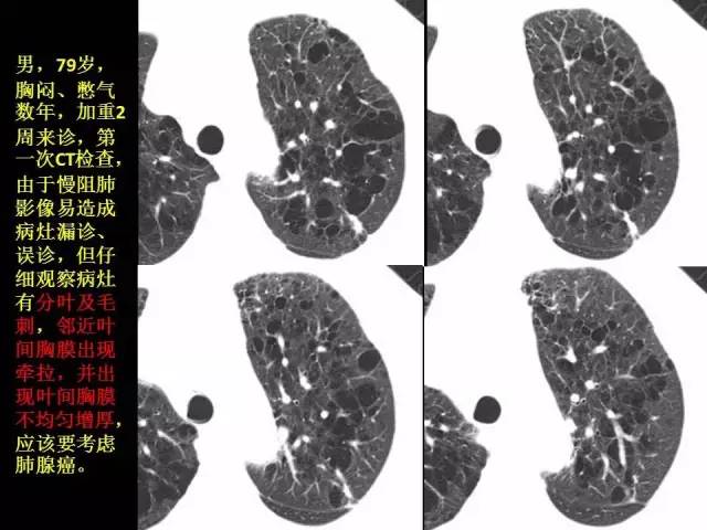 【PPT】肺内孤立性小结节的CT诊断探析