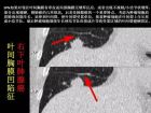 肺内孤立性小结节的CT诊断探析