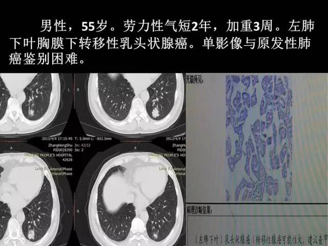 【PPT】肺内孤立性小结节的CT诊断探析