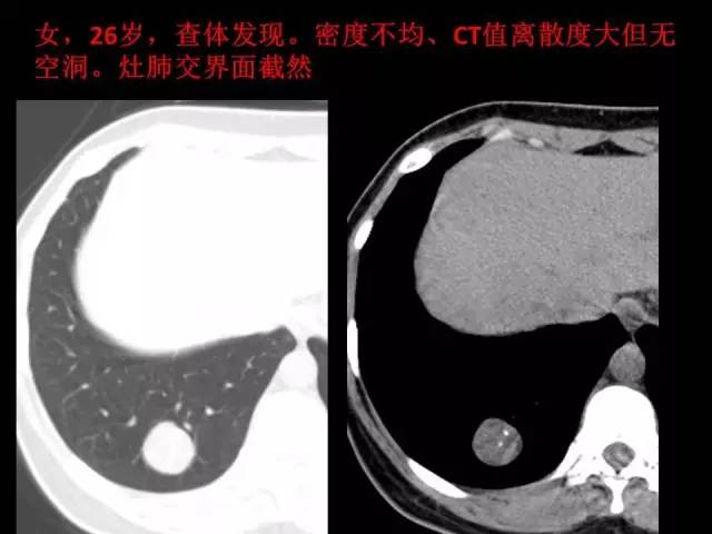 【PPT】肺内孤立性小结节的CT诊断探析