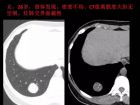 肺内孤立性小结节的CT诊断探析