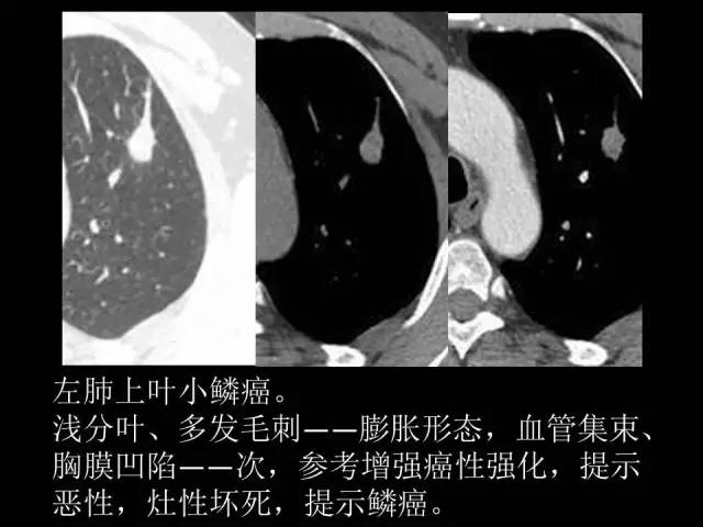 【PPT】肺内孤立性小结节的CT诊断探析