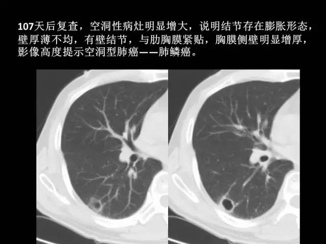 【PPT】肺内孤立性小结节的CT诊断探析