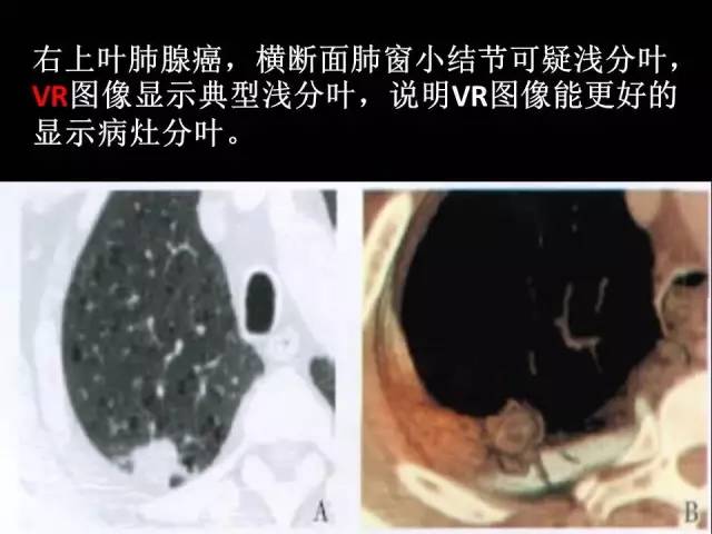 【PPT】肺内孤立性小结节的CT诊断探析