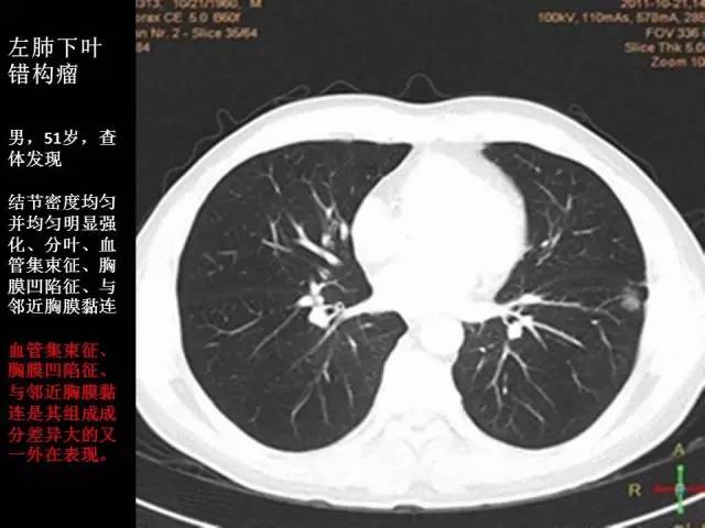【PPT】肺内孤立性小结节的CT诊断探析