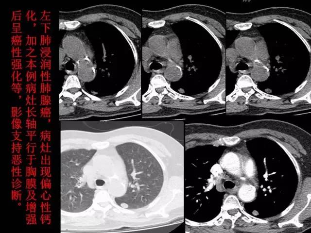 【PPT】肺内孤立性小结节的CT诊断探析