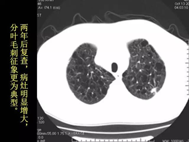 【PPT】肺内孤立性小结节的CT诊断探析