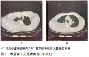 术后第1天患者胸腔积液