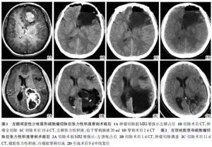 胶质瘤术后