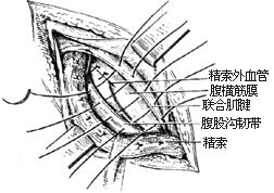腹股沟斜疝 腹股沟斜疝