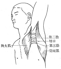 胸廓出口综合征 胸廓出口综合征