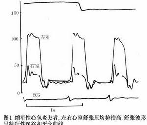 慢性缩窄性心包炎 慢性缩窄性心包炎