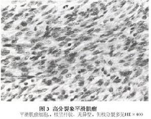 高分裂象平滑肌瘤