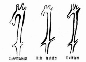 多发性大动脉炎