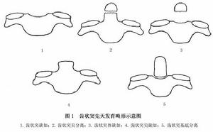 (图)单纯性寰枢椎脱位 (图)单纯性寰枢椎脱位