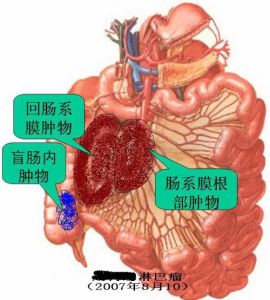 小肠肿瘤
