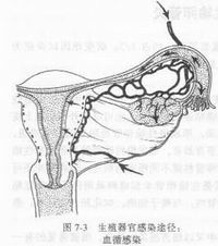 子宫内膜异位症 子宫内膜异位症