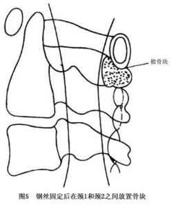 (图)单纯性寰枢椎脱位 (图)单纯性寰枢椎脱位