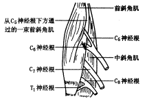 胸廓出口综合征