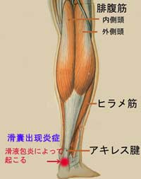跟腱前囊炎 跟腱前囊炎