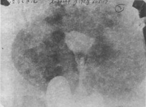 照1 子宫肌瘤的子宫造影象(子宫右角粘膜下肌瘤造影象，显示该部充盈缺损)