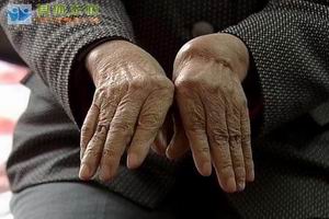 类风湿性关节炎