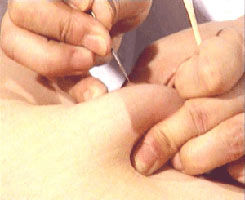 急性胆囊炎