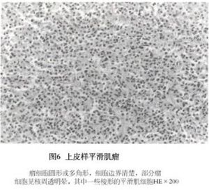 上皮样平滑肌瘤