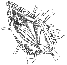 腹股沟斜疝 腹股沟斜疝