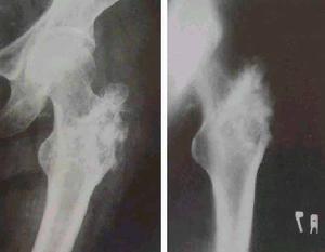 骶髂关节结核 骶髂关节结核