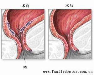 肛门瘙痒 肛门瘙痒