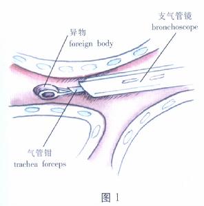 气管、支气管异物