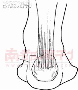 跟腱前囊炎 跟腱前囊炎