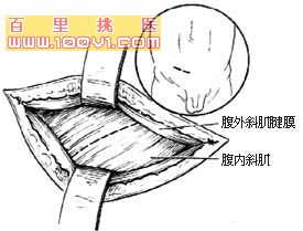 腹股沟斜疝 腹股沟斜疝