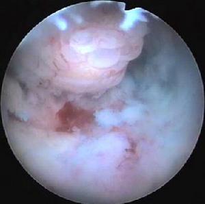 （图）子宫内膜息肉