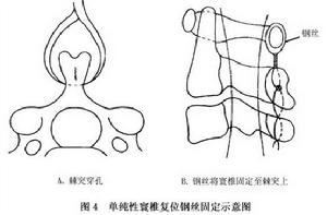 (图)单纯性寰枢椎脱位 (图)单纯性寰枢椎脱位