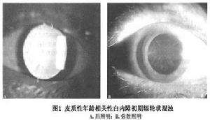 年龄相关性白内障 年龄相关性白内障