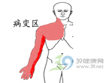 胸廓出口综合征 胸廓出口综合征