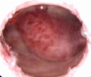 （图）子宫内膜息肉