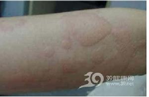 慢性荨麻疹